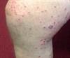 Derm Dx: An asymptomatic eruption on the legs and trunk Derm Dx: An asymptomatic eruption on the legs and trunk