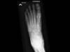 Ortho Dx: What is the best treatment for this foot injury? Ortho Dx: What is the best treatment for this foot injury?
