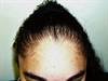 Derm Dx: Hair loss in a 15-year-old female Derm Dx: Hair loss in a 15-year-old female