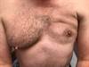 Image of the Week: Do you recognize this chest abnormality? Image of the Week: Do you recognize this chest abnormality?