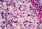 Gastroesophageal adenocarcinoma patients benefit from adjuvant chemotherapy Gastroesophageal adenocarcinoma patients benefit from adjuvant chemotherapy