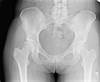 Ortho Dx: A woman with a hip that is popping out of place Ortho Dx: A woman with a hip that is popping out of place