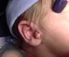 Derm Dx: Flesh-colored lesions on an infant Derm Dx: Flesh-colored lesions on an infant
