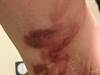 Image of the Week: Painful lesions in the armpits Image of the Week: Painful lesions in the armpits