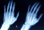 Case Study: Cardiac conditions of rheumatoid arthritis Case Study: Cardiac conditions of rheumatoid arthritis