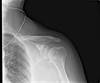 Ortho Dx: What is the best treatment for this shoulder pain? Ortho Dx: What is the best treatment for this shoulder pain?
