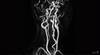 Image of the Week: What is causing this patient's headaches? Image of the Week: What is causing this patient's headaches?