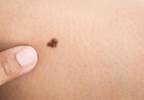 AJCC melanoma staging system is revised AJCC melanoma staging system is revised