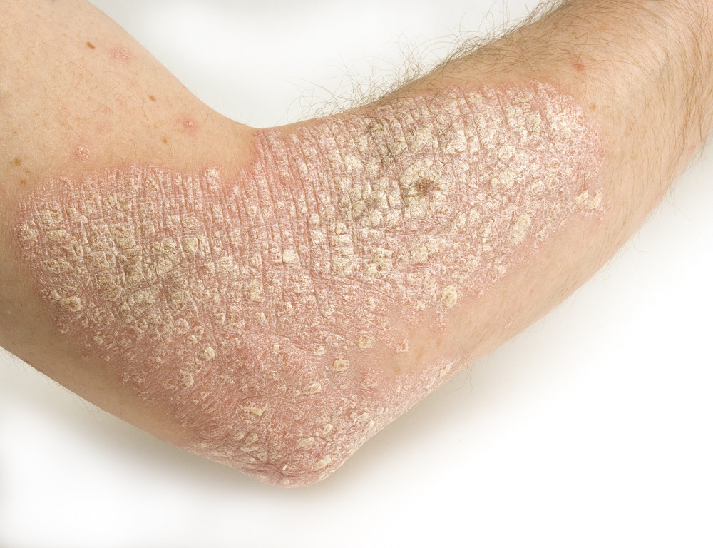 Severe Psoriasis Linked To Higher Mortality Risk The Clinical Advisor