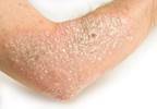 Severe psoriasis linked to higher mortality risk Severe psoriasis linked to higher mortality risk