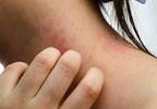 Methotrexate treatment improves symptoms of severe atopic dermatitis Methotrexate treatment improves symptoms of severe atopic dermatitis