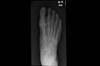 Ortho Dx: Foot pain that is worse in the morning Ortho Dx: Foot pain that is worse in the morning