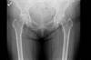 Ortho Dx: A 67-year-old woman with activity-related thigh pain Ortho Dx: A 67-year-old woman with activity-related thigh pain