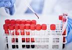 Hepatitis increases mortality rates in HIV patients Hepatitis increases mortality rates in HIV patients