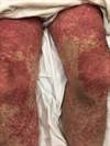 Nonblanching Rash and Diarrhea: What's the Diagnosis? Nonblanching Rash and Diarrhea: What's the Diagnosis?