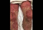 Case Study: Diarrhea and rash Case Study: Diarrhea and rash