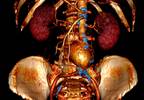 Endovascular strategy more effective than open repair for ruptured abdominal aortic aneurysms Endovascular strategy more effective than open repair for ruptured abdominal aortic aneurysms