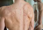 Adolescent acne not linked to malignant melanoma in men Adolescent acne not linked to malignant melanoma in men