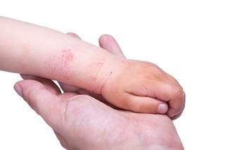 Medication-related adverse events occur more frequently with methotrexate in children with moderate to severe psoriasis. Medication-related adverse events occur more frequently with methotrexate in children with moderate to severe psoriasis.