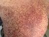 Image of the Week: Can you identify these cutaneous findings? Image of the Week: Can you identify these cutaneous findings?