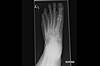 Ortho Dx: Progressively worsening foot pain Ortho Dx: Progressively worsening foot pain