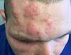 DermDx: Headache, Malaise, and a Rash DermDx: Headache, Malaise, and a Rash
