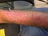 DermDx: Thin Erythematous Plaques On Upper Arms and Hands DermDx: Thin Erythematous Plaques On Upper Arms and Hands