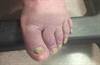 Image of the Week: Recurrent pleural effusions and yellow nails Image of the Week: Recurrent pleural effusions and yellow nails