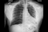 Ortho Dx: What is the best treatment for these rib fractures? Ortho Dx: What is the best treatment for these rib fractures?