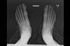 Ortho Dx: Chronic foot pain and deformity Ortho Dx: Chronic foot pain and deformity