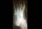 Case Study: Foot pain after jogging Case Study: Foot pain after jogging