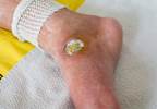 FDA approves shock wave device to treat diabetic foot ulcers FDA approves shock wave device to treat diabetic foot ulcers