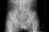 Ortho Dx: Hip pain after a split-type fall Ortho Dx: Hip pain after a split-type fall