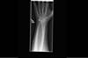 Ortho Dx: Wrist pain and collapse of the lunate Ortho Dx: Wrist pain and collapse of the lunate