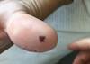 Image of the Week: Fever, heart murmur, and Janeway lesions Image of the Week: Fever, heart murmur, and Janeway lesions