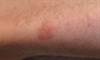 Derm Dx: An asymptomatic rash on the lower extremities Derm Dx: An asymptomatic rash on the lower extremities