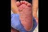 DermDx: Papules on the Feet of an Infant DermDx: Papules on the Feet of an Infant