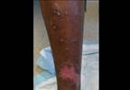 Cutaneous leishmaniasis: A potential treatment option Cutaneous leishmaniasis: A potential treatment option