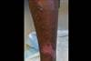 DermDx: Nonpruritic, Hyperpigmented Rash in Recent Traveler DermDx: Nonpruritic, Hyperpigmented Rash in Recent Traveler
