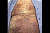 DermDx: Rash on Arms and Trunk With Hyperpigmentation DermDx: Rash on Arms and Trunk With Hyperpigmentation