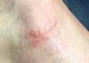 Image of the Week: A pruritic, erythematous lesion on the foot Image of the Week: A pruritic, erythematous lesion on the foot