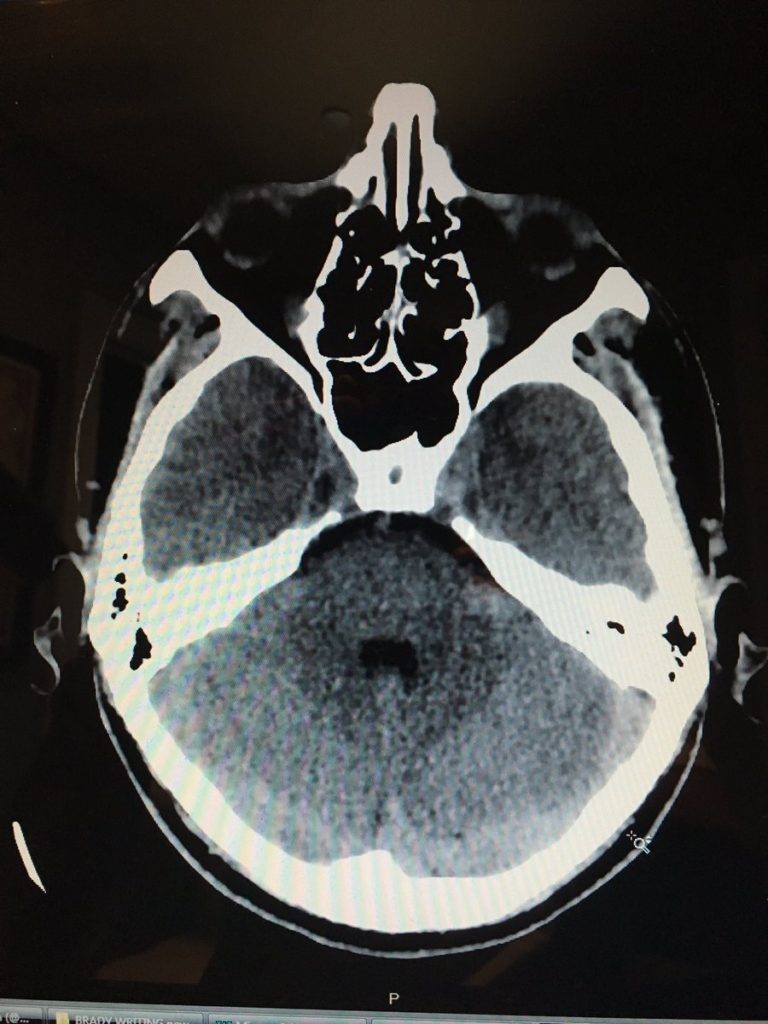 Vertigo Ct Ct Or Vertigo Ct Ct Or