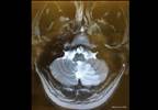 Case Study: Dizziness in a 42-year-old man Case Study: Dizziness in a 42-year-old man