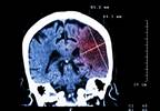 Acute ischemic stroke: new guidelines open treatment window to 24 hours Acute ischemic stroke: new guidelines open treatment window to 24 hours
