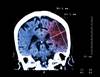 Acute ischemic stroke: new guidelines open treatment window to 24 hours Acute ischemic stroke: new guidelines open treatment window to 24 hours