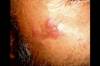 DermDx: Asymptomatic Rash on the Cheek and Forehead DermDx: Asymptomatic Rash on the Cheek and Forehead