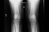 Ortho Dx: Arthritis of the knee Ortho Dx: Arthritis of the knee