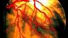 Coronary artery disease: primary prevention measures Coronary artery disease: primary prevention measures