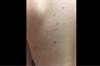 Image of the Week: Salmon-pink, scaly papules Image of the Week: Salmon-pink, scaly papules