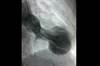 Image of the Week: Acute chest pain and dyspnea Image of the Week: Acute chest pain and dyspnea